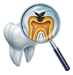 Tooth Decay Treatment in Marshall IL