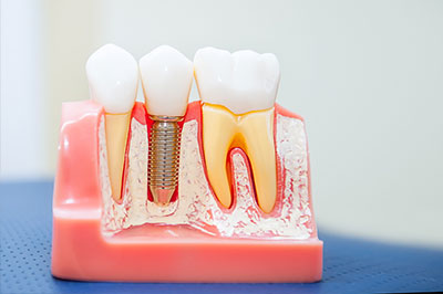 Dental Implants in Marshall IL
